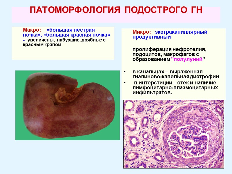 ПАТОМОРФОЛОГИЯ ПОДОСТРОГО ГН        Макро:   